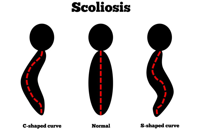 Ojai, CA scoliosis treatment